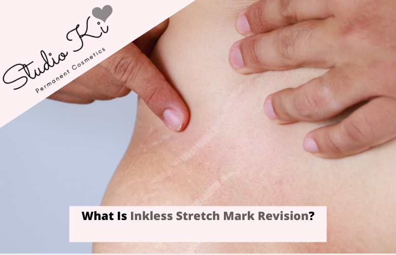 What Is Inkless Stretch Mark Revision?